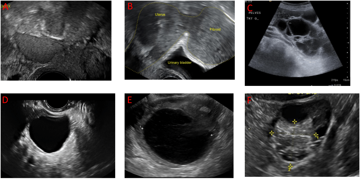 Gynecological Adnexal Masses