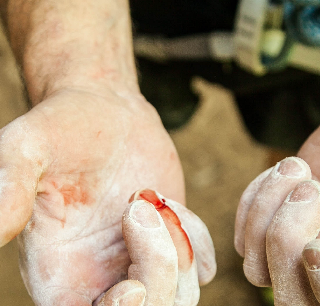 A man shows a bleeding hand